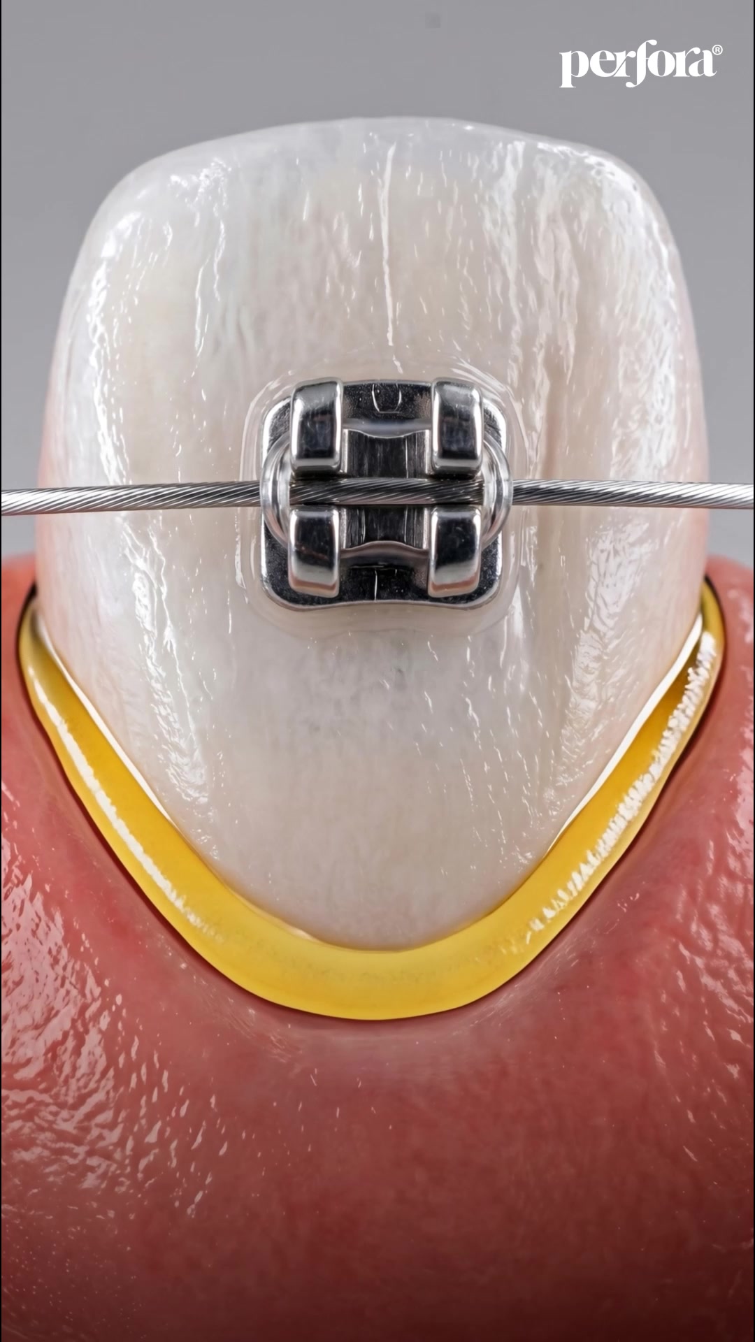 Perfora Meta ad: the same plaque-removal visual running as a second ad