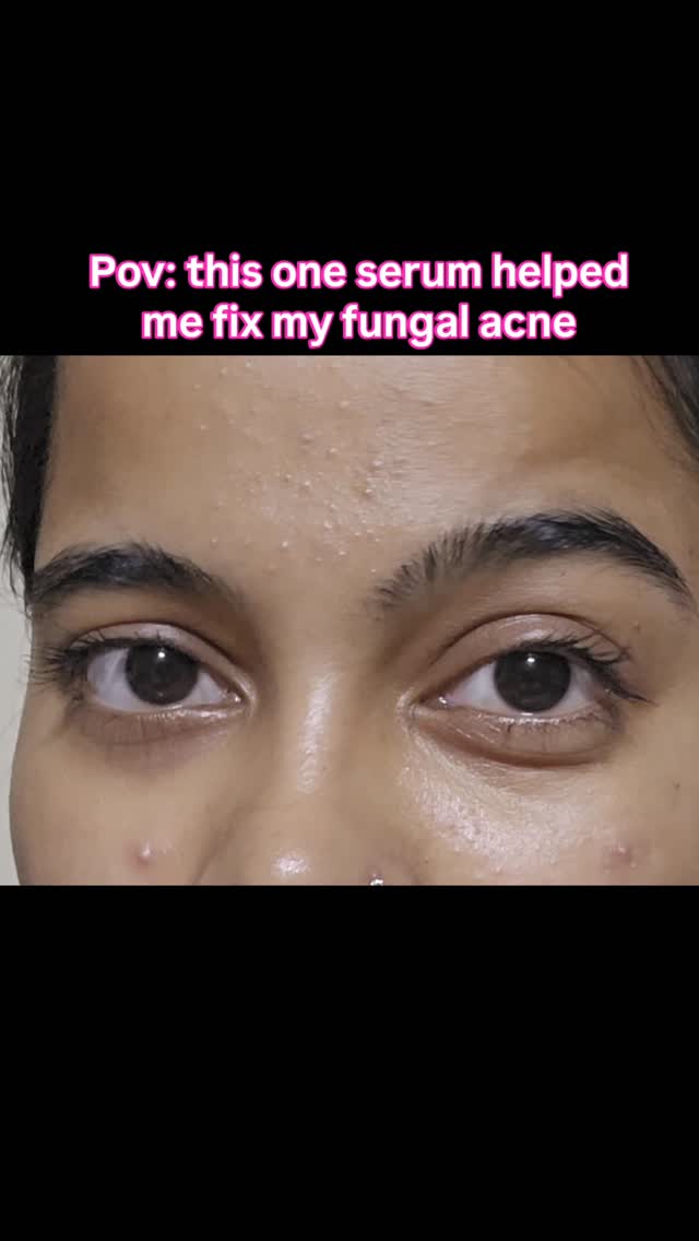 Foxtale UGC video ad opening on close-up skin with the caption "Pov: this one serum helped me fix my fungal acne"